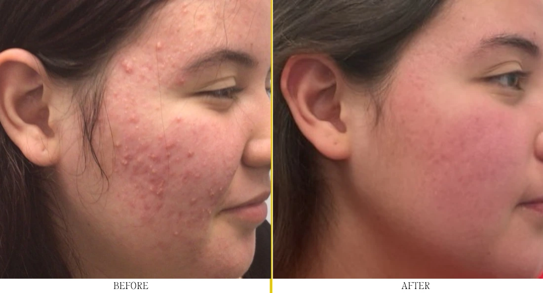 Acne Treatment - Case 8