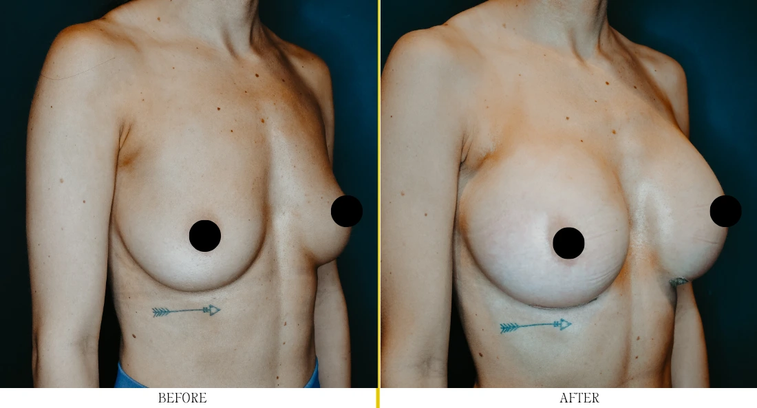 Breast Augmentation – Case 29