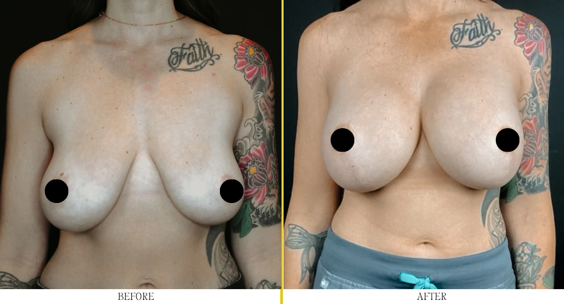 Breast Augmentation - Case 28