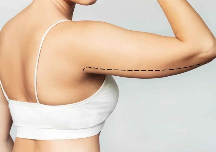 What Is an Arm Lift (Brachioplasty) Phoenix, AZ Banner
