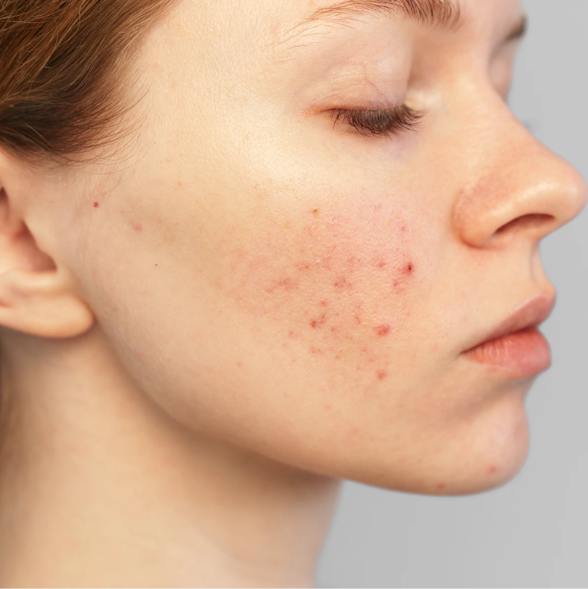 Acne Treatment in Phoenix, AZ Banner