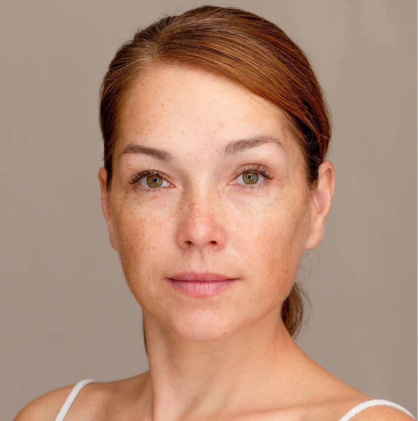 Benefits of Brown Spot Treatment Phoenix, Arizona Banner