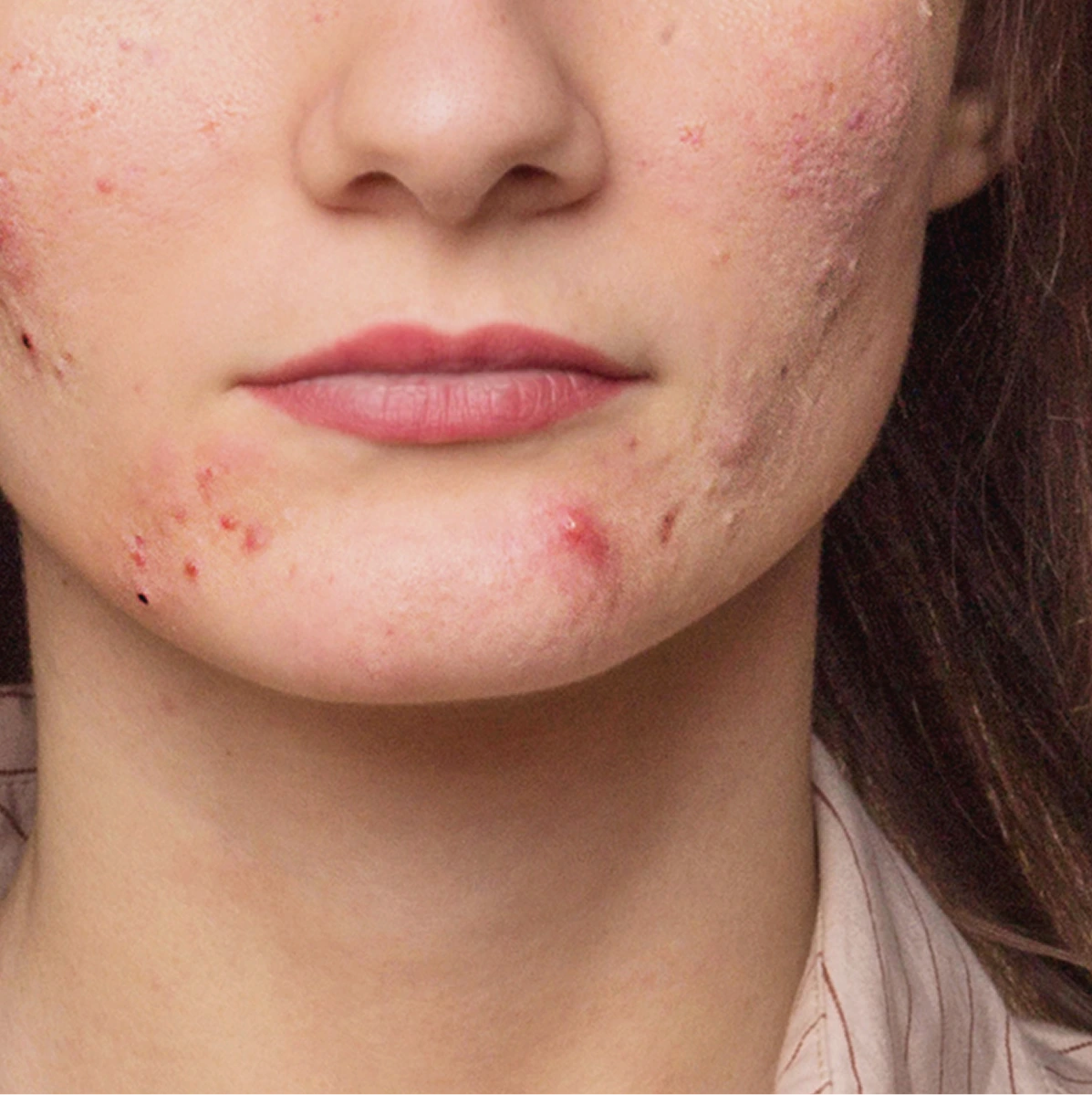 Boil Treatment in Phoenix, AZ Banner