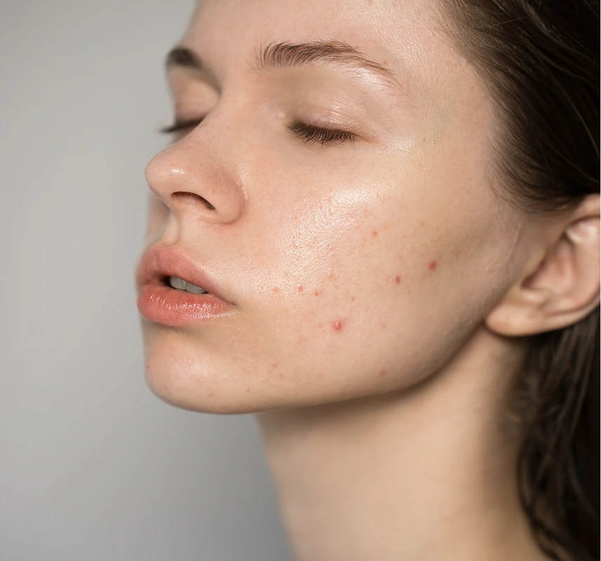 Candidates for Acne Treatment in Phoenix, Arizona Banner