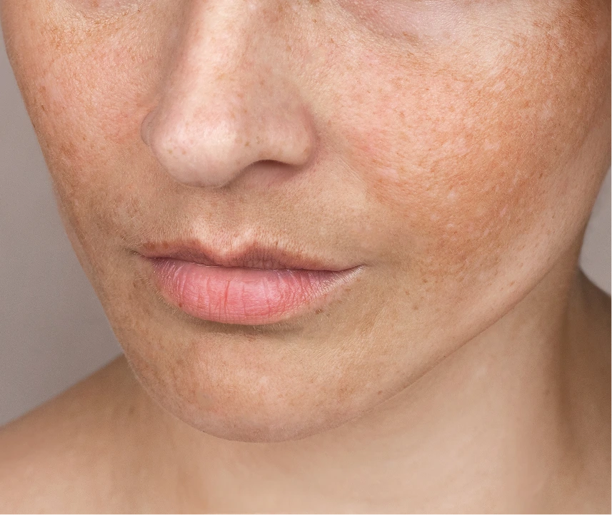 What Are Brown/Age Spots Treatment Phoenix, AZ Banner