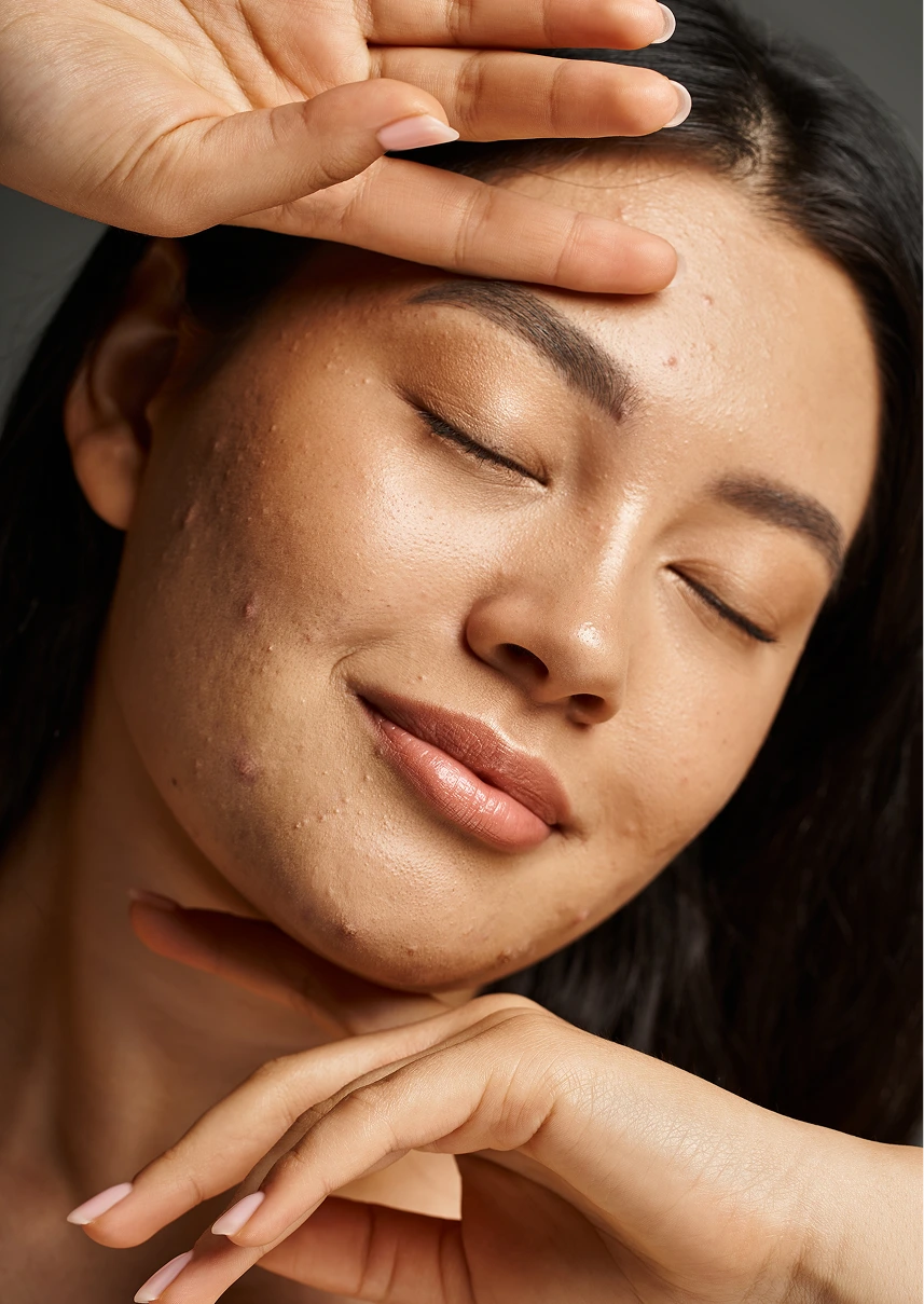 What Causes Acne to Develop Acne Treatment Phoenix, AZ Banner