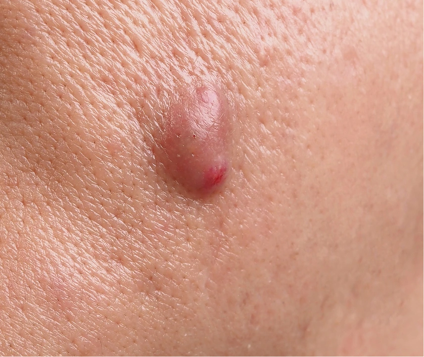 What Is a Boil Treatment Phoenix, AZ Banner