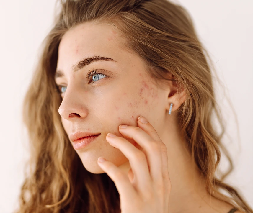 What Is Acne Treatment in Phoenix, AZ Banner
