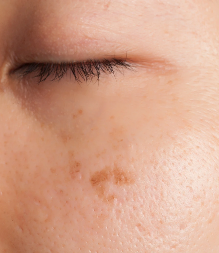 What to Expect During Your Appointment Brown Spot Treatment in Phoenix, Arizona Banner