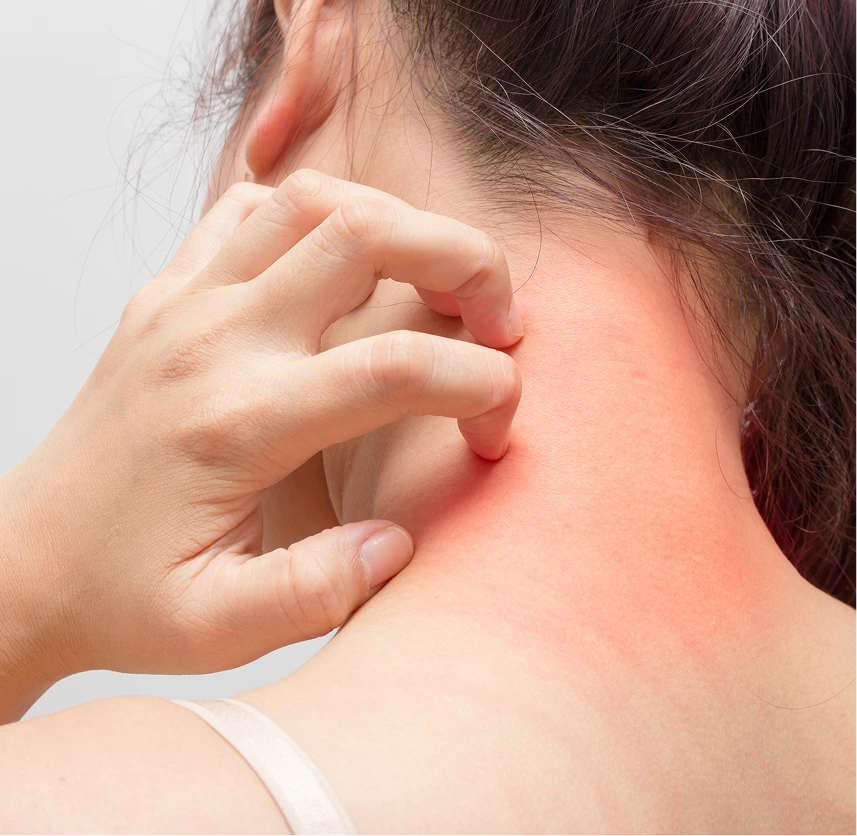 Chronic Eczema Treatment Phoenix Banner