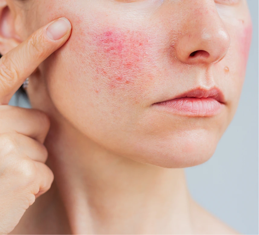 Eczema Therapy Phoenix Banner