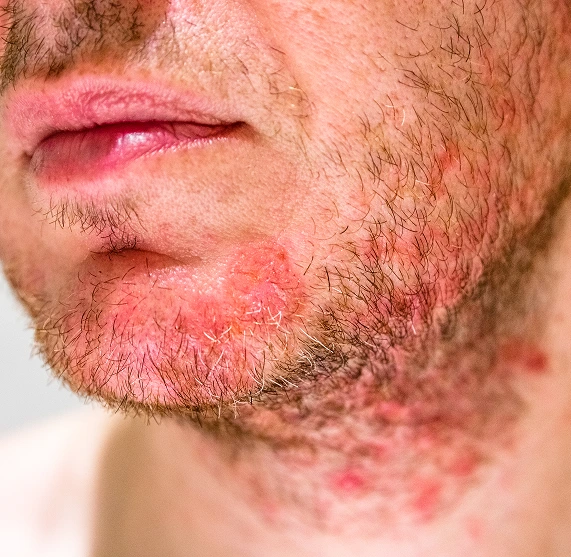 Folliculitis Specialist Phoenix, AZ Banner