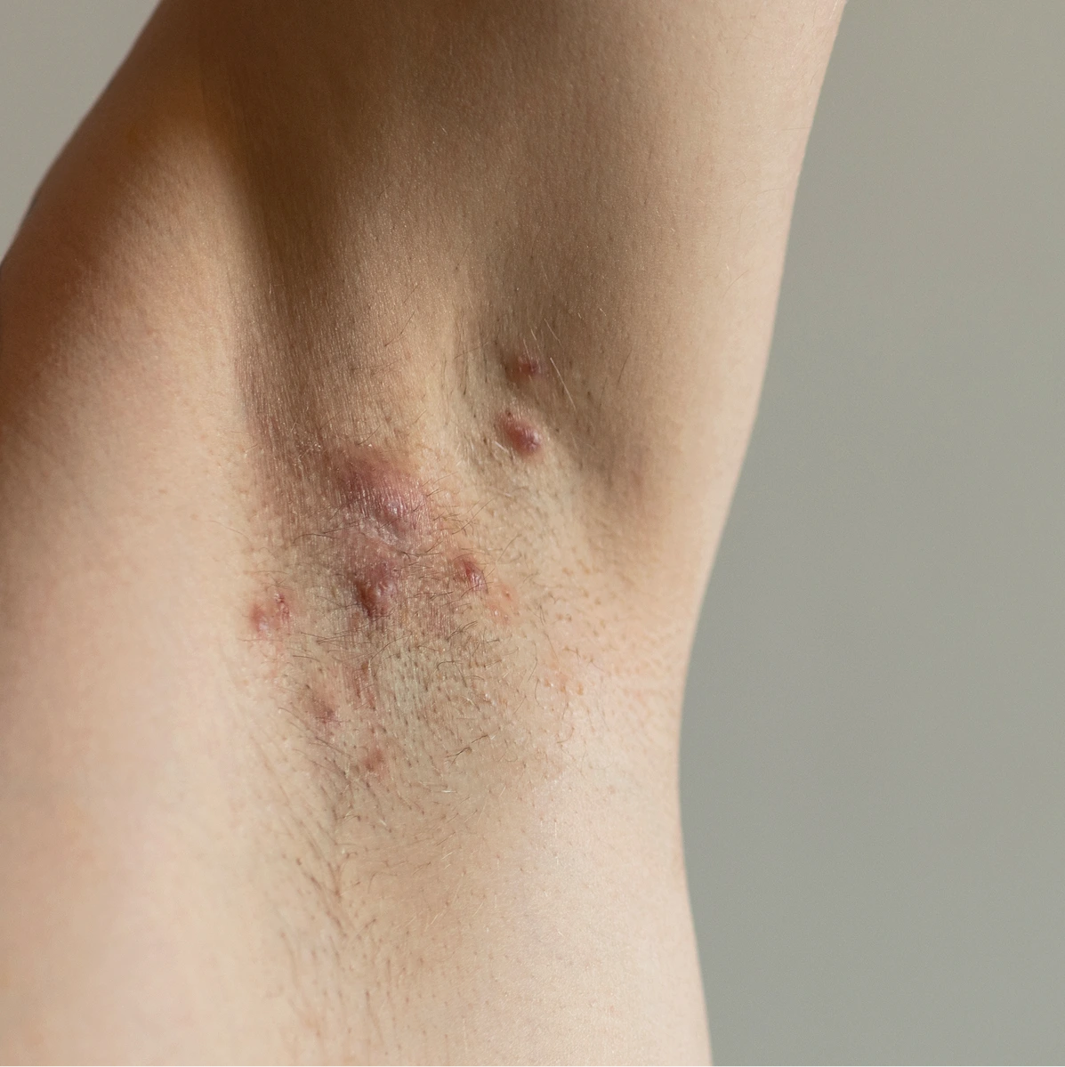 Hidradenitis Suppurativa Treatment in Phoenix, AZ Banner