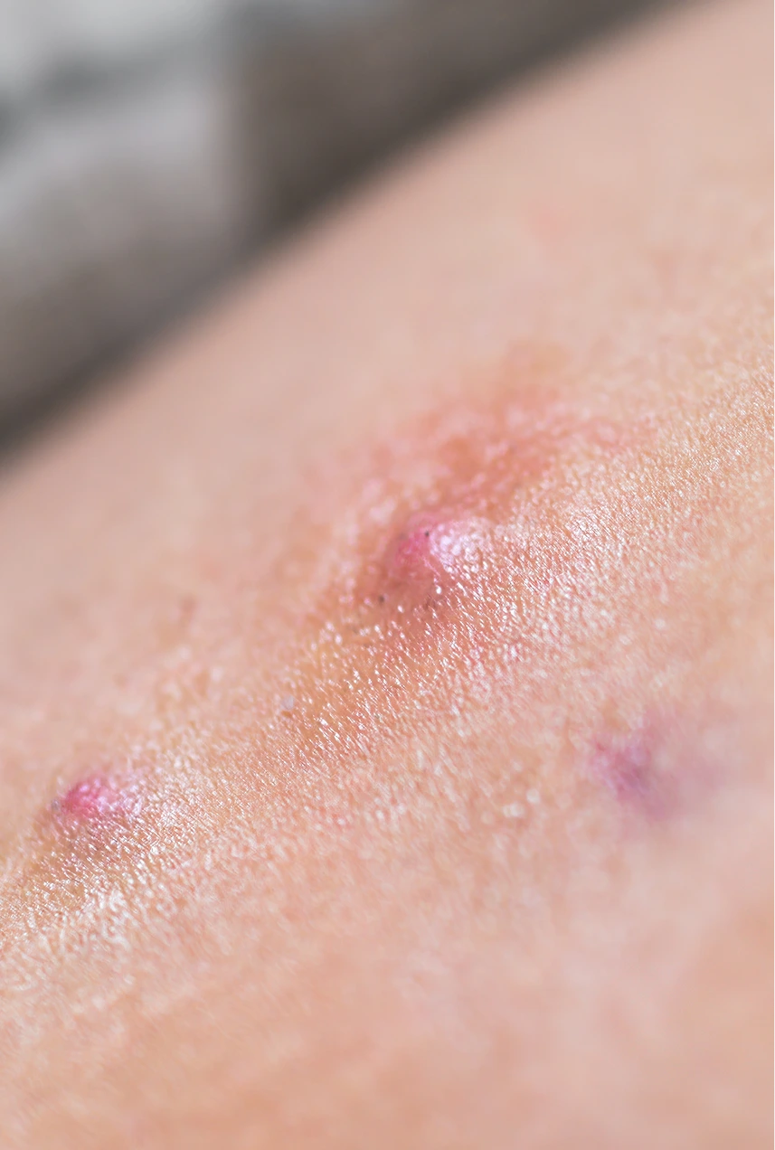 Hidradenitis Suppurativa Treatment Phoenix, AZ Banner