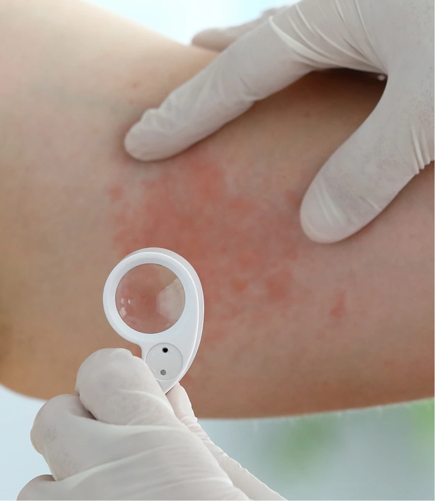 Hives Treatment in Phoenix, Arizona Banner