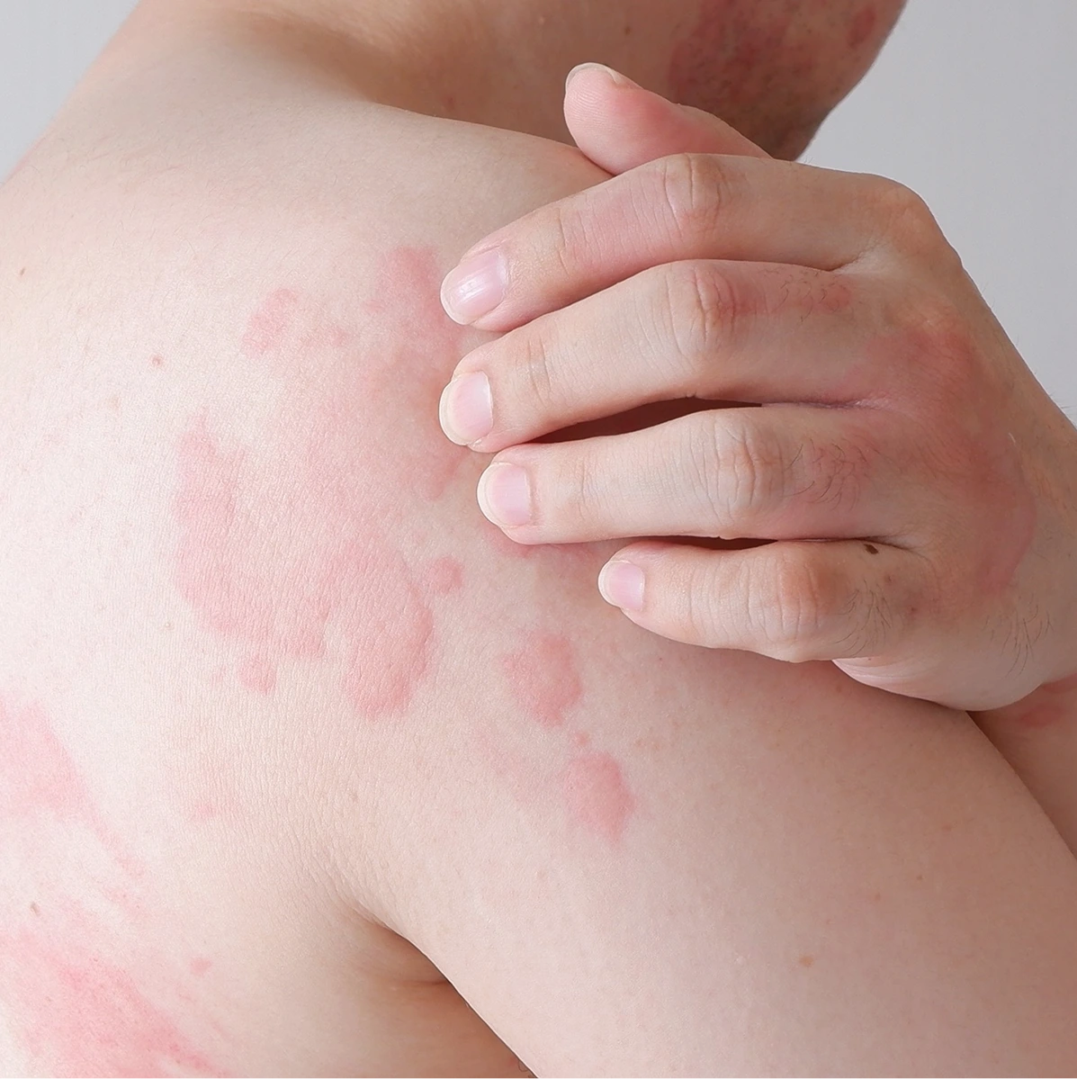 Hives Treatment in Phoenix, AZ Banner