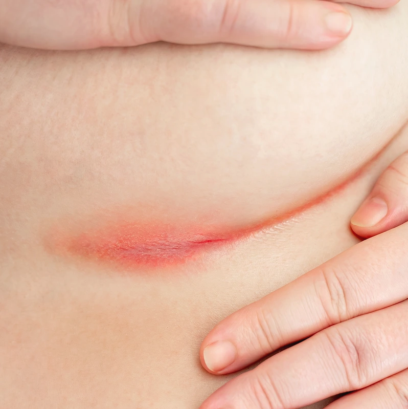 Intertrigo Treatment in Phoenix, AZ Banner