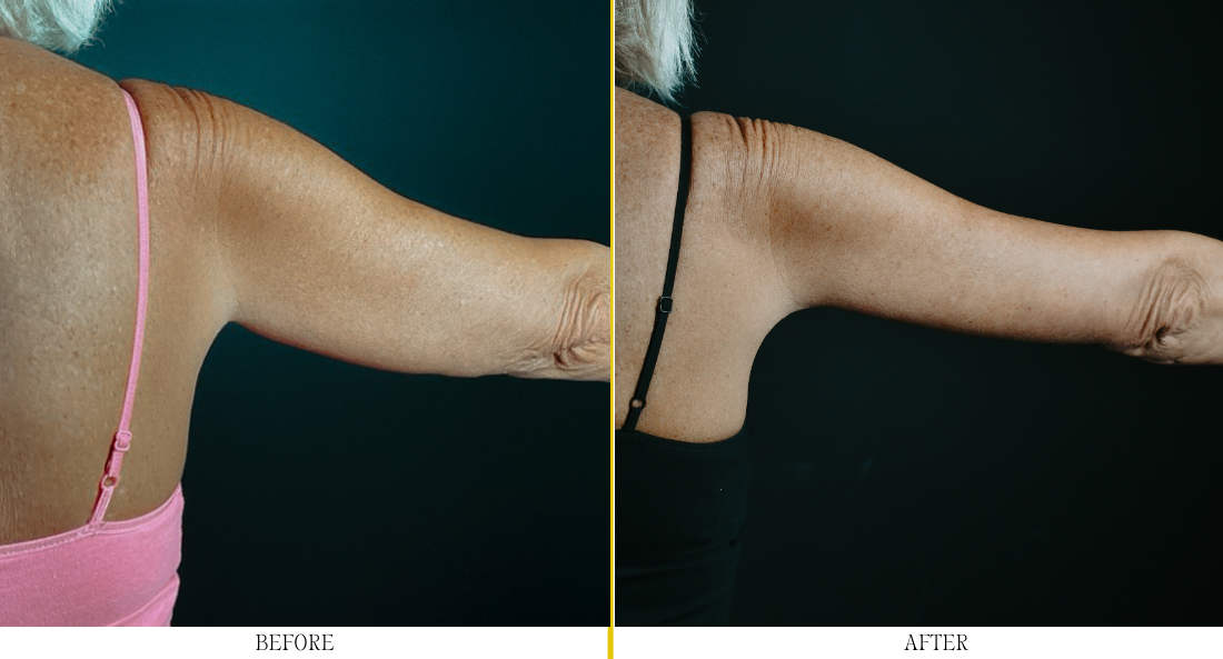 Brachioplasty - Case 3