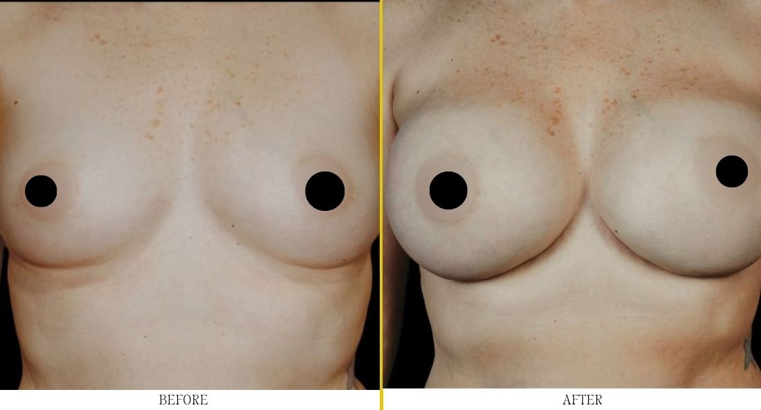 Breast-aug-Case-30
