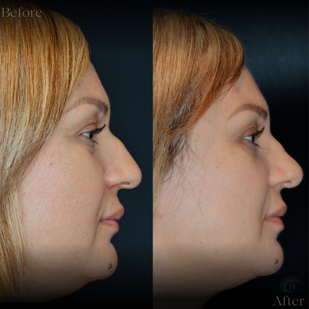 Rhinoplasty-Case 13