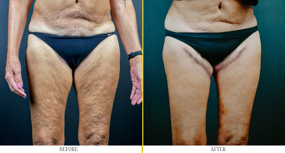 Thigh Lift - Case 2